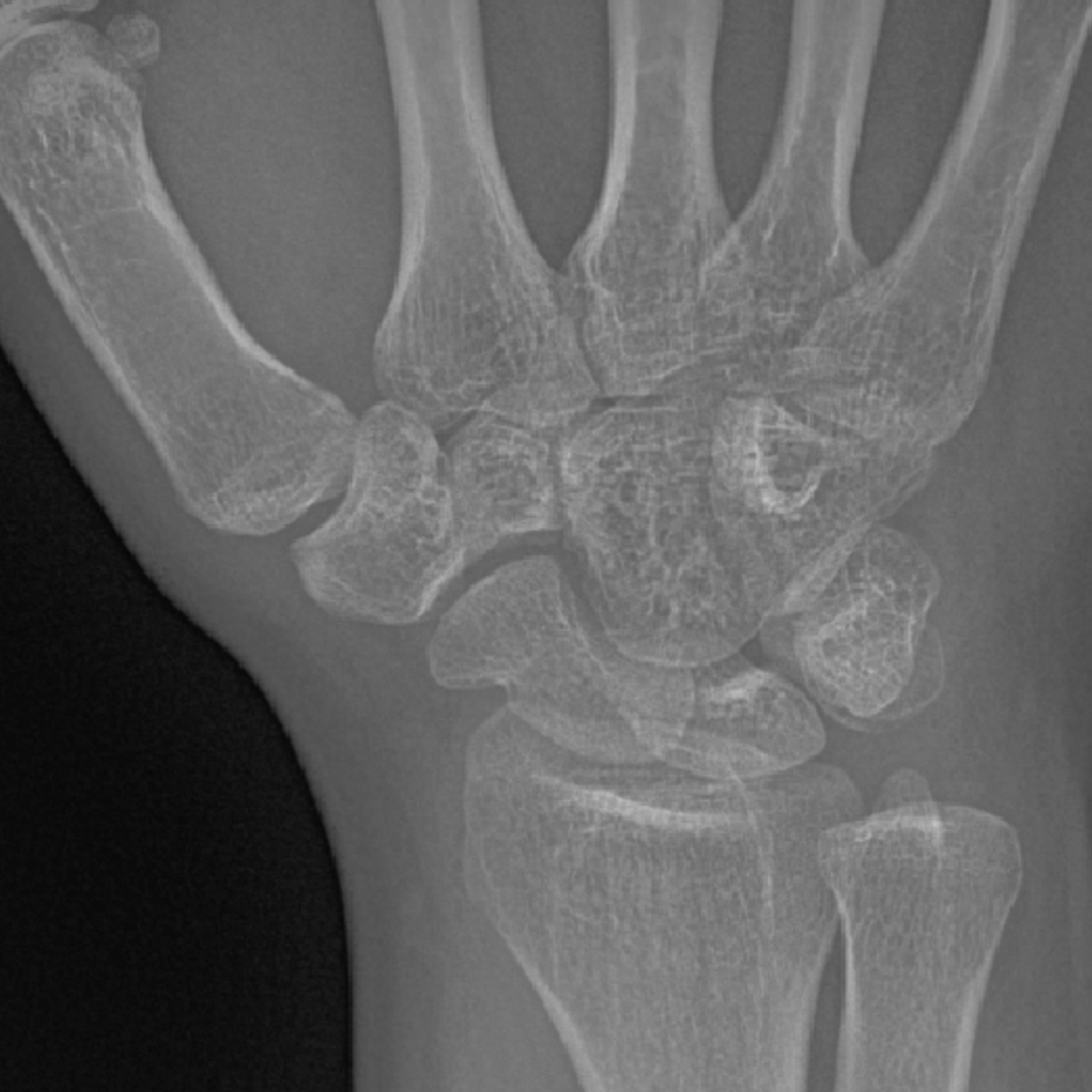 Pediatric hand x-ray for juvenile idiopathic arthritis imaging
