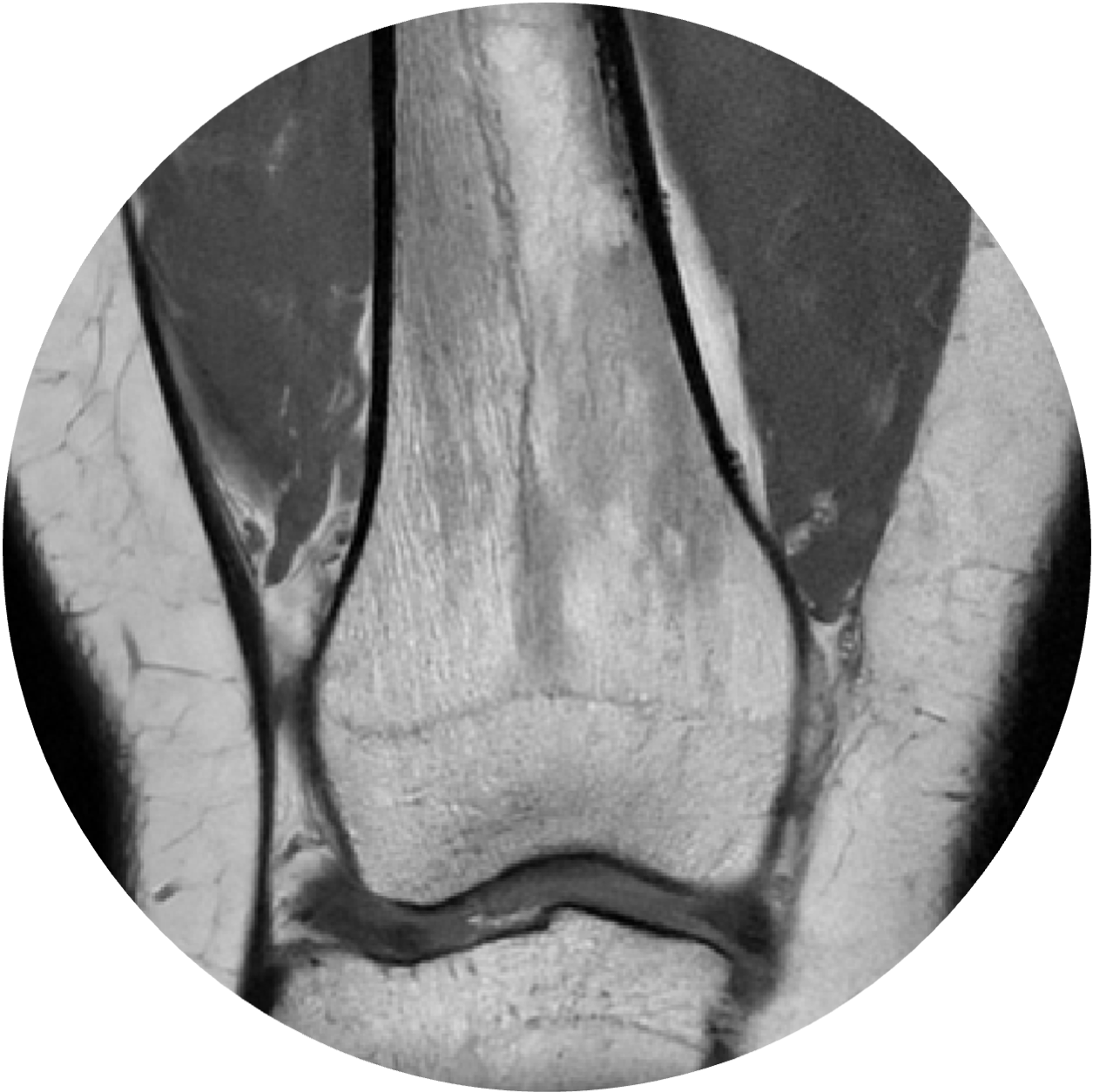 Knee imaging used to study pediatric musculoskeletal health