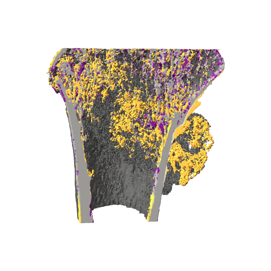 Three-dimensional fracture healing visualization with highlighted bone remodeling regions