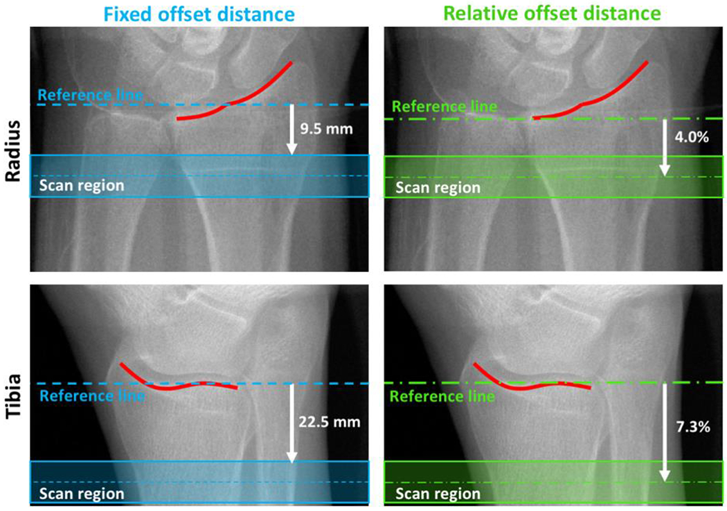 Guidelines for the assessment of bone density and microarchitecture in vivo using high-resolution peripheral quantitative computed tomography.
