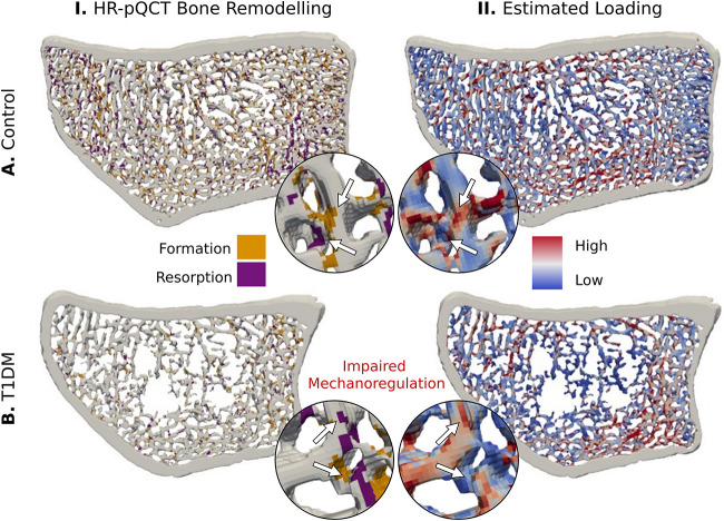 Bone remodeling and responsiveness to mechanical stimuli in individuals with type 1 diabetes mellitus.