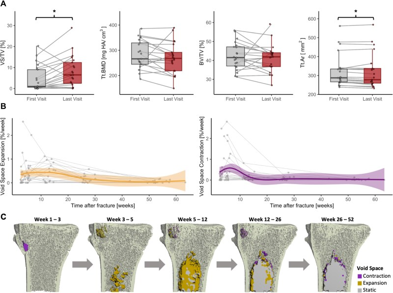 Structural alterations during fracture healing lead to void spaces developing in surrounding bone microarchitecture.