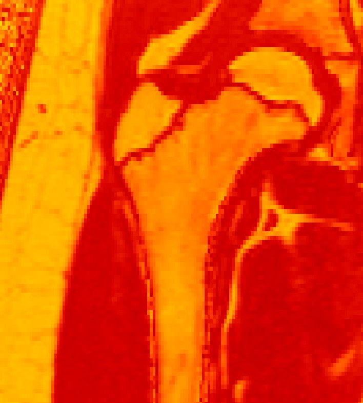 Bone marrow adipose tissue imaging example